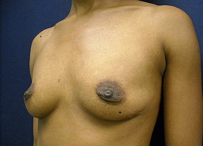 Chicago Breast Augmentation Surgery, Chicago Breast Enhancement & Chicago Breast Implants